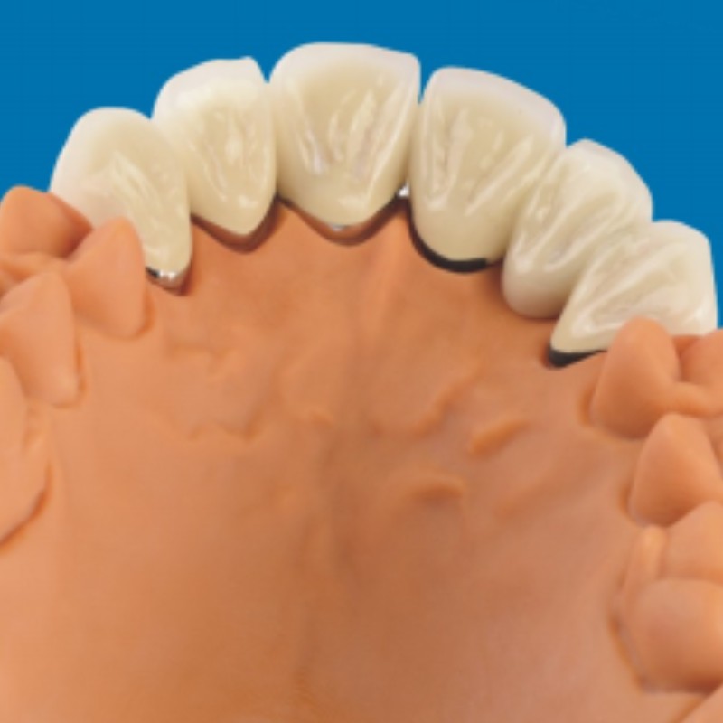 Métal-dents en porcelaine