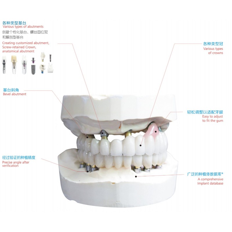 implant dentaire